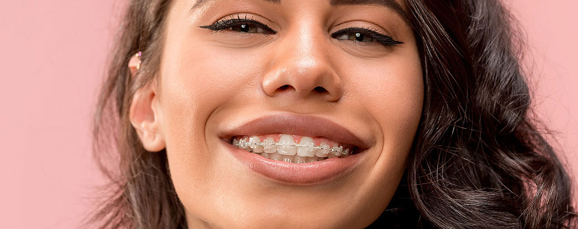 img-chawlaorthodontics-treatment-braces-ceramicbraces-02 img-chawlaorthodontics-treatment-braces-ceramicbraces-02