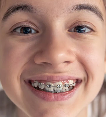 img-chawlaorthodontics-treatment-braces-metalbraces-01