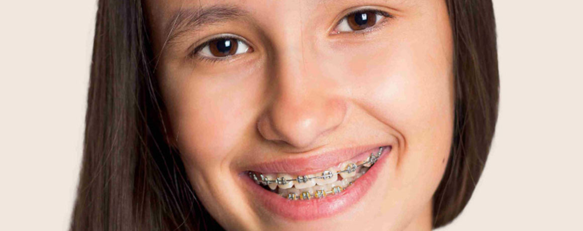 img-chawlaorthodontics-treatment-braces-metalbraces-02