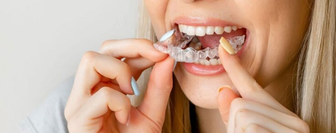 img-smilemaintenance-retainerassurance-02 img-smilemaintenance-retainerassurance-02