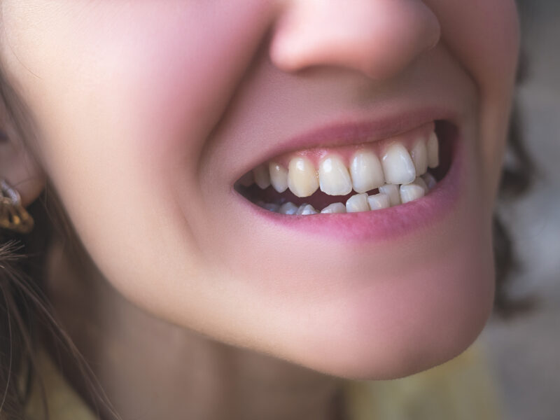 fix crooked teeth villa park il orthodontist