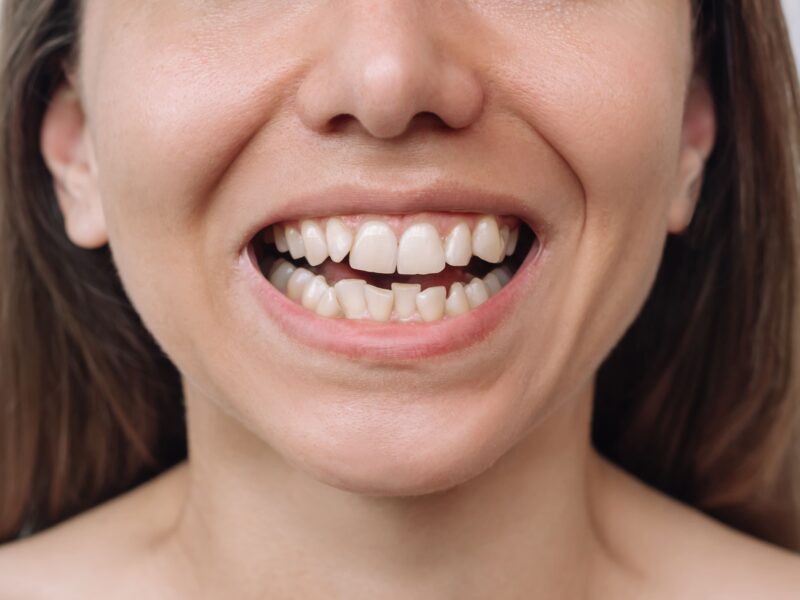 crowded teeth braces westmont